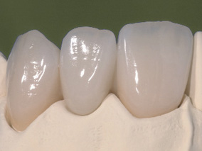 протезирование зубов виды и цены